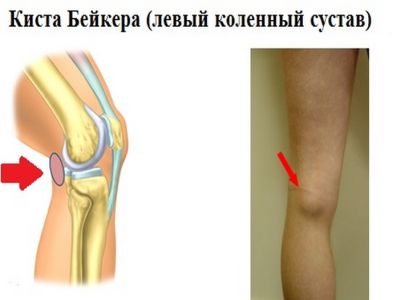 Что такое киста в коленном суставе воспаление коленного сустава методы лечения
